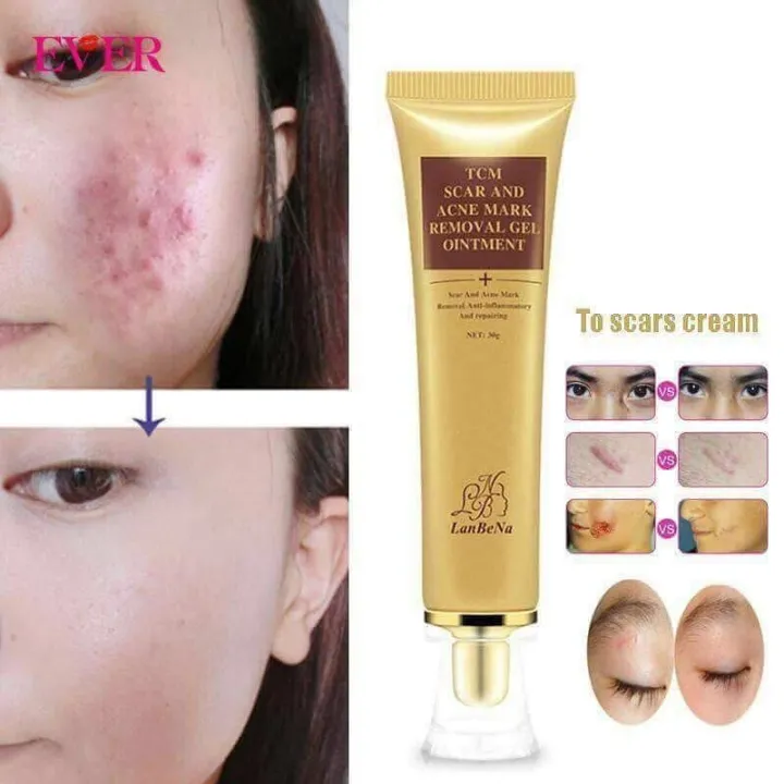 LANBENA%20TCM%20scar%20and%20Acne%20Spot%20Removal%20Gel%20Ointment%20-%20Image%204