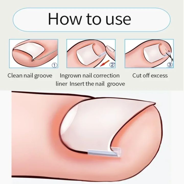10pcs%20Ingrown%20Toenail%20Correction%20Tool%20Ingrown%20Toe%20Nail%20Treatment%20Elastic%20Patch%20Sticker%20Straightening%20Clip%20Brace%20Pedicure%20Tool%20-%20Image%203