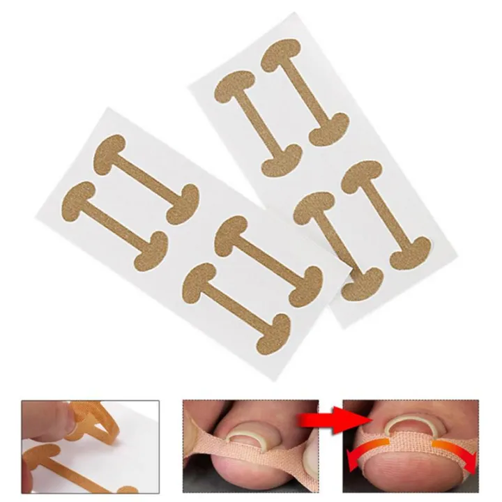 1/5pc%20Toe%20sticker%20Nail%20Strips%20Anti-roll%20Nail%20Glue%20Toe%20Inlay%20Nail%20Corrector%20Stickers%20Nail%20Patch%20Ingrown%20Toenail%20Correction%20Tool%20-%20Image%203