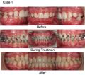 Dental Orthodontic Metal Bracket Bracets Hook 3 YAS. 
