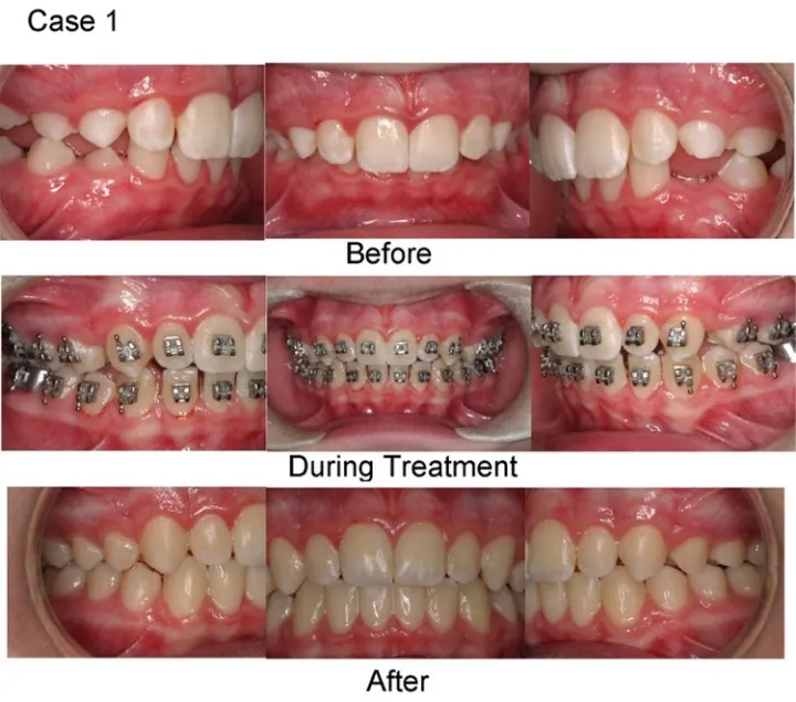 Dental%20Orthodontic%20Metal%20Bracket%20Bracets%20Hook%203%20YAS%20-%20Image%205