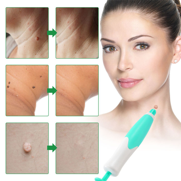 %E3%80%90WSJJ%20Store%E3%80%91(New)%20elaimei%20double%20headed%20wart%20removing%20pen%20set%20Dark%20Spot%20Remover%20skin%20wart%20tag%20remover%20tool%20skin%20care%20tool%20-%20Image%205