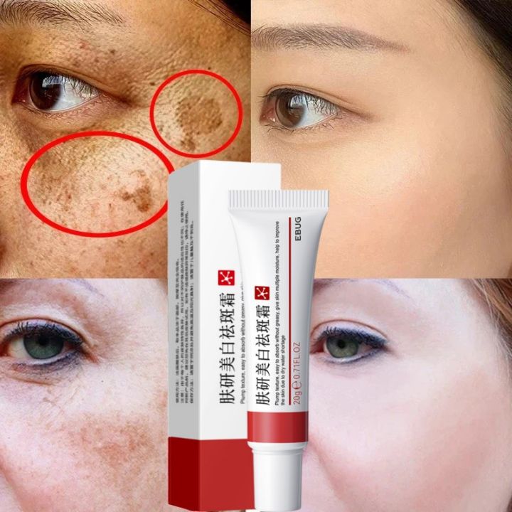 Face%20Dark%20Spots%20Remover%20for%20Women%20Remove%20Melasma%20Freckles%20Cream%20Removal%20Melanin%20Whitening%20Cream%20Fade%20Spots%20Skin%20Brightening%20Care%20-%20Image%202