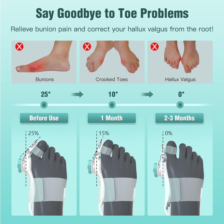 UM%20Bunion%20Corrector%20for%20Women%20Big%20Toe,%20Orthopedic%20Toe%20Straighteners%20for%20Men,%20Adjustable%20Bunion%20Splint%20for%20Bunion%20Relief%20with%20Knob%20Correction,%20Inner%20Silicone%20Pad%20and%20Anti-slip%20Heel%20Strap(1PC)%20-%20Image%204