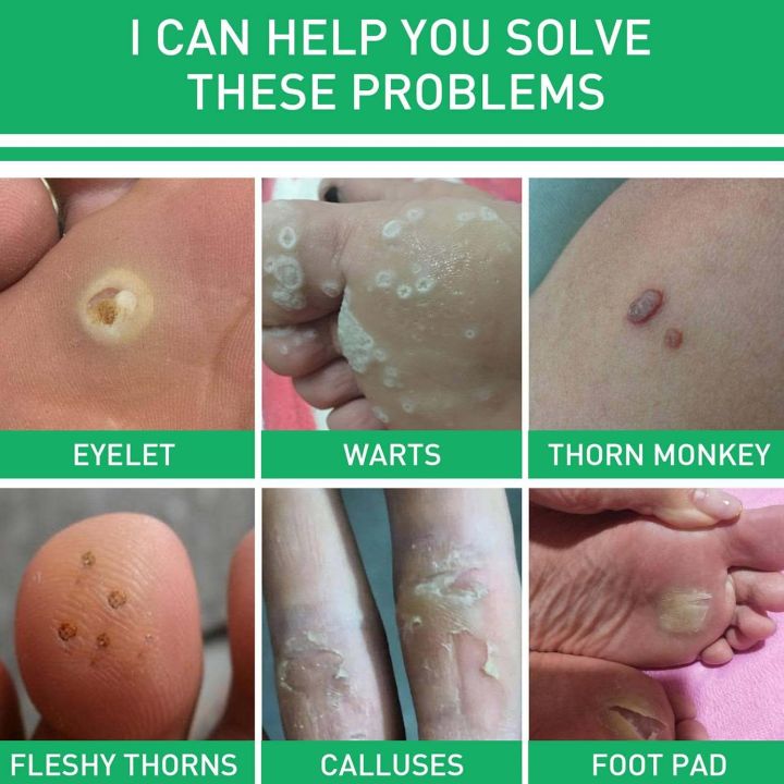 Corn%20Remover%20Strengthen%20Gel,Corn%20Remover%20Gel%20Extra%20Strength,Instant%20Blemish%20Removal%20Gel,Wart%20Remover%20Liquid,Corn%20Remover%20Liquid%20for%20Feet%20Toes%20Hands%20Care,Easy%20to%20Remove%20Calluses%20-%20Image%205