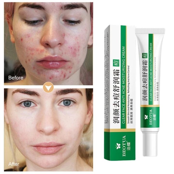 Aloe%20Vera%20Gel%20Anti%20Acne%20Treatment%20Pimples%20And%20Acne%20Remover%20Cream%20Facial%20Moisturizer%20Glowing%20Skin%20Korean%20Skin%20Care%20Products%2020g%20-%20Image%202