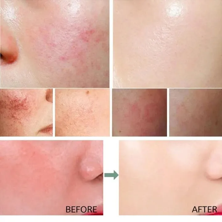 Effective%20Facial%20Redness%20Repair%20Cream%20Rosacea%20Treat%20Sensitive%20Skin%20Dryness%20Moisturizer%20Hydrating%20Sooth%20Lotion%20Korean%20Cosmetics%20-%20Image%202