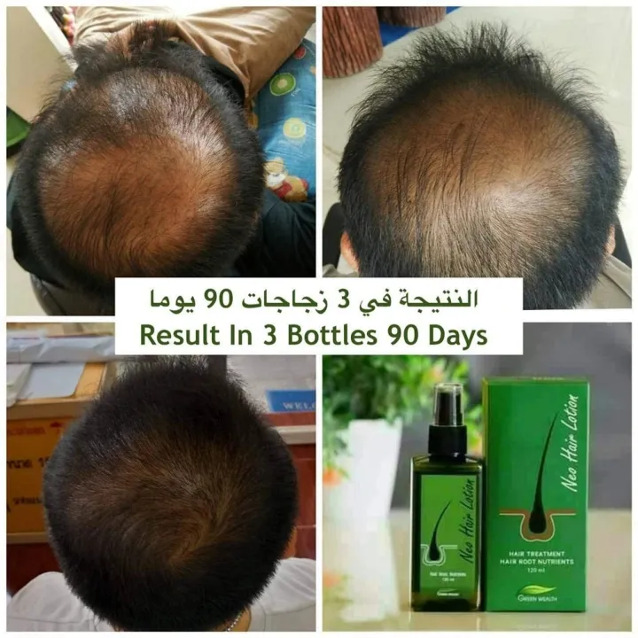 2PCS/SET%20Natural%20Thailand%20Neo%20Hair%20Lotion%20Hair%20Care%20Oil%20Hair%20Grow%20Serum%20Essential%20Hair%20Loss%20Treatment%20Product%20Hair%20Growth%20120ML%20-%20Image%206