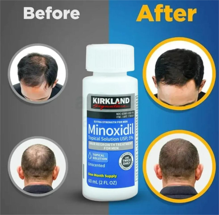 Kirkland%205%25%20Minoxidil%20Extra%20Strength%20Hair%20Loss%20&%20Hair%20Regrowth%20Treatment%20for%20Men/Women%2060ml%20Orginal%20-%20Image%202
