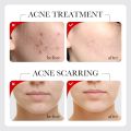 SADOER Fruit Acid AHA+BHA Acne Repair Serum- 30ml.