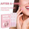 108 Acne Patch Pimple Patch, Pink Heart Star Shaped Acne Absorbing Cover Patch, Hydrocolloid Acne Patches For Face Zit Patch A. 
