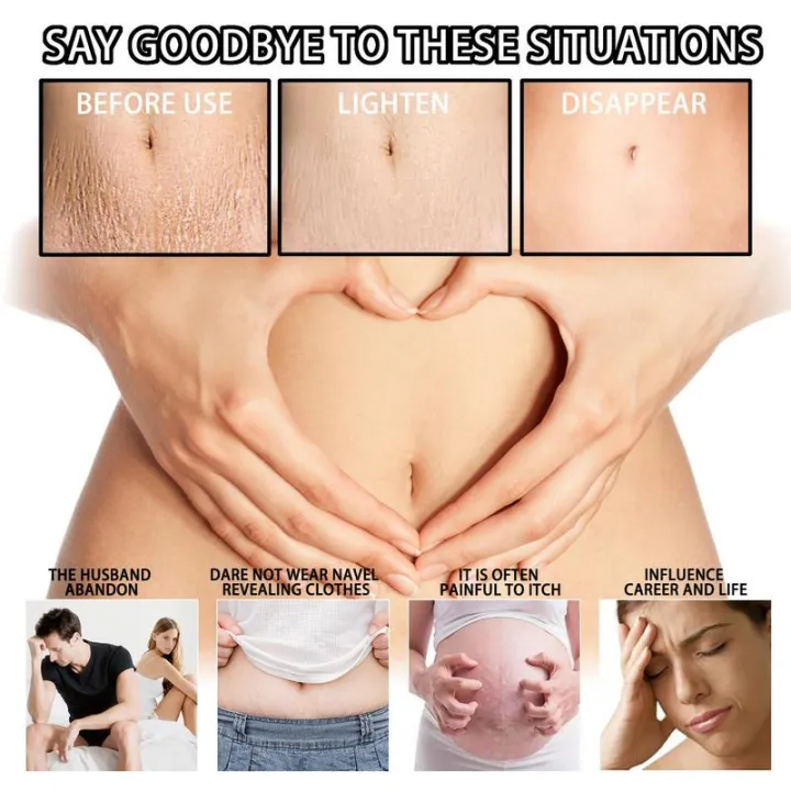 Stretch%20Mark%20Remover%20Cream%20With%20Coconut%20Sunflower%20Oil%2050ml%20Natural%20Beeswax%20Maternity%20Skin%20Care%20Freckl%20Spot%20Repair%20Massage%20Lotion%20-%20Image%204