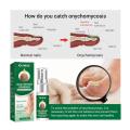 Nail Fungal Treatment Serum Anti Infection Toe Fungus Repair Liquid Cuticle Paronychia Onychomycosis Hand Foot Nail Care Essence. 