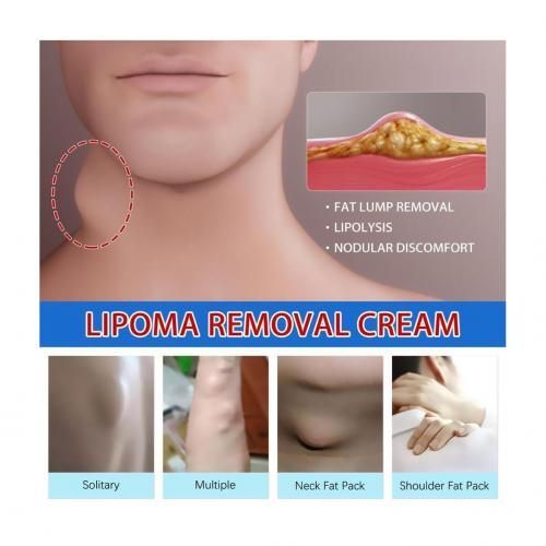South%20Moon%20Lipoma%20Removal%20Cream%20Lipolysis%20Fat%20Lump%20Relieve%20Plaster%20Skin%20Swelling%20Ointment%20Subcutaneous%20Lumps%20Dredge%20Dissipate%20Body%20Care%20-%20Image%203