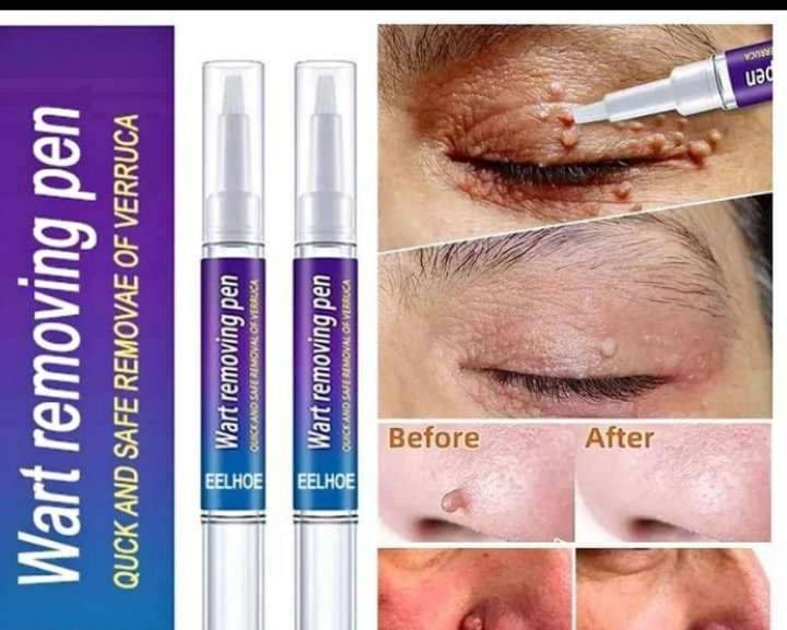 Wart%20Remover%20Pen%20-%20Image%204