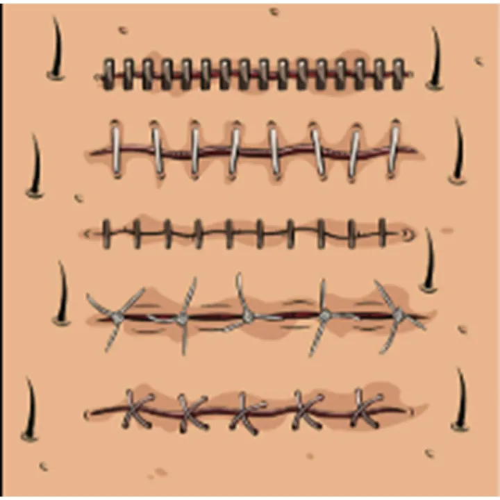 Absorbable%20Suture%20Brown%20chromic%20Catgut%20%E2%80%93%20Medgut%201-0%20(4%20Metric),%2076cm%20%7C%203/8%20Circle%20Round%20body%20Needle%20%E2%80%93%2040mm%201%20Pcs%20-%20Image%203
