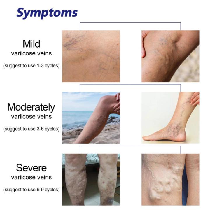 %E3%80%90Top-Rated%20Product%E3%80%91%20Varicose%20Veins%20Spray%20Spider%20Veins%20Relief%20Vasculitis%20Phlebitis%20Spider%20Pain%20Relief%20Plaster%20Care%2030ml%20-%20Image%205