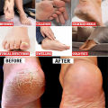 EELHOE Anti Crack Foot Hand Gel Ginger  Cuticles Care Anti-Drying Healing Crack Frost Mask Dead Skin Removal Deep Moisturizing Feet Crack Whitening Smooth Feet Care. 