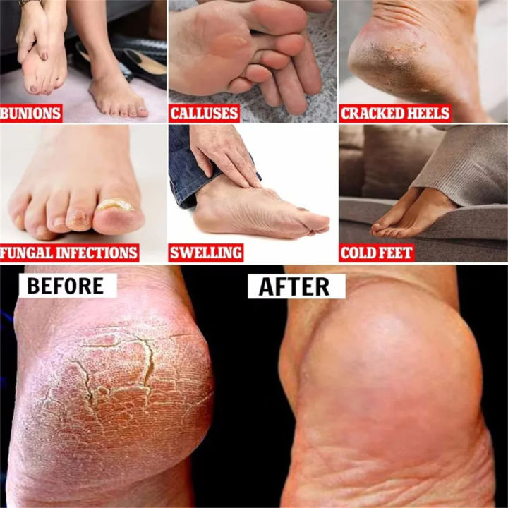 EELHOE%20Anti%20Crack%20Foot%20Hand%20Gel%20Ginger%20%20Cuticles%20Care%20Anti-Drying%20Healing%20Crack%20Frost%20Mask%20Dead%20Skin%20Removal%20Deep%20Moisturizing%20Feet%20Crack%20Whitening%20Smooth%20Feet%20Care%20-%20Image%208