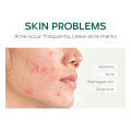 Laikou 8G Herbal Anti-Acne Cream. 