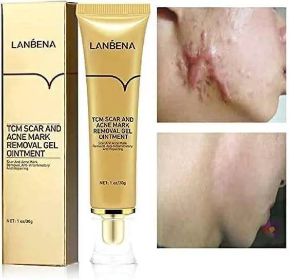 LANBENA%20TCM%20scar%20and%20Acne%20Spot%20Removal%20Gel%20Ointment%20-%20Image%205