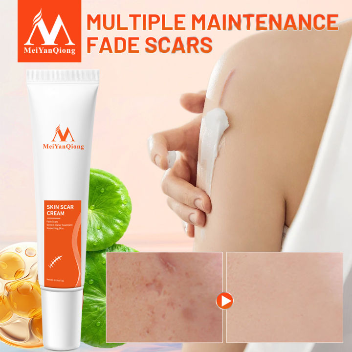 MeiYanQiong%20Acne%20Scar%20Remove%20Scar%20Cream%20Skin%20Repair%20Stretch%20Marks%20Keloid%20Remover%20Desalination%20Scar%20Face%20Cream%20Spots%20Effective%20Treatment%2015g%20-%20Image%202