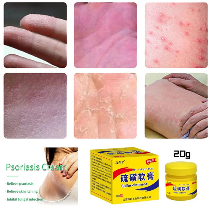 Sulfur%20Antibacterial%20Cream%20Soap%20Spray%20Set%20Psoriasis%20Eczema%20Anti-itch%20Relief%20Rash%20Urticaria%20Desquamation%20Ointment%20Body%20Skin%20Care%20-%20Image%204