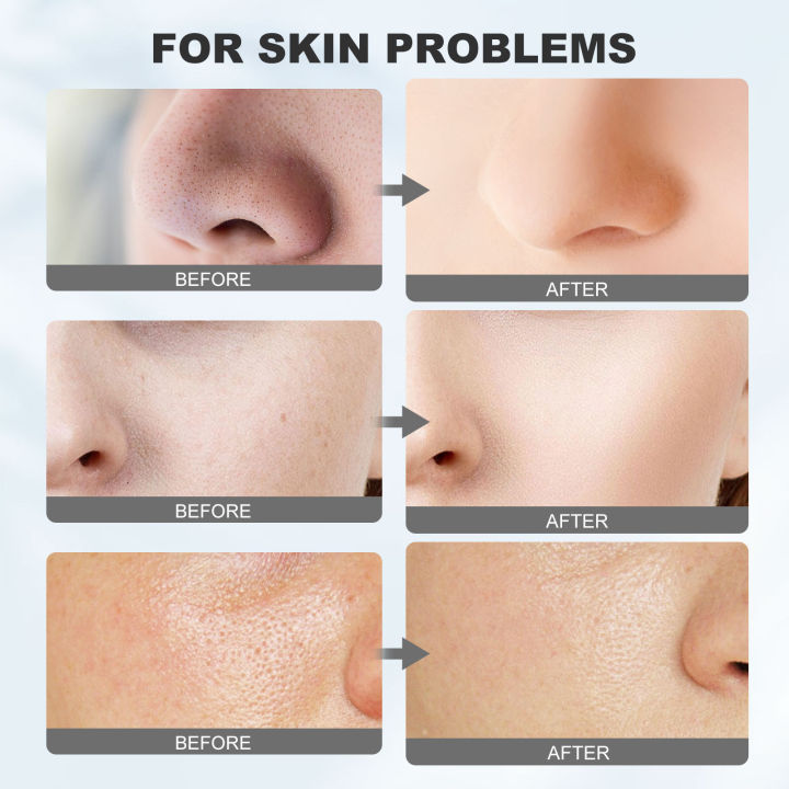 Mud%20Mask%20for%20Face%20Dead%20Sea%20Remove%20Pimples%20Blackhead%20Purifying%20Mild%20Hydrating%20Cleansing%20Anti%20Acne%20Marks%20Lighten%20Melanin%20Clay%20Care%20-%20Image%203