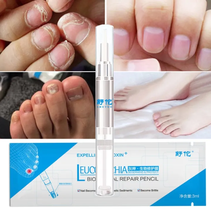 Gentle%20ingredients%20skin%20friendly%20and%20no%20side%20effect%203ML%20Fungal%20Nail%20Treatment%20Pen%20Onychomycosis%20Paronychia%20Anti%20Fungal%20Nail%20Infection%20Chinese%20Herbal%20-%20Image%207