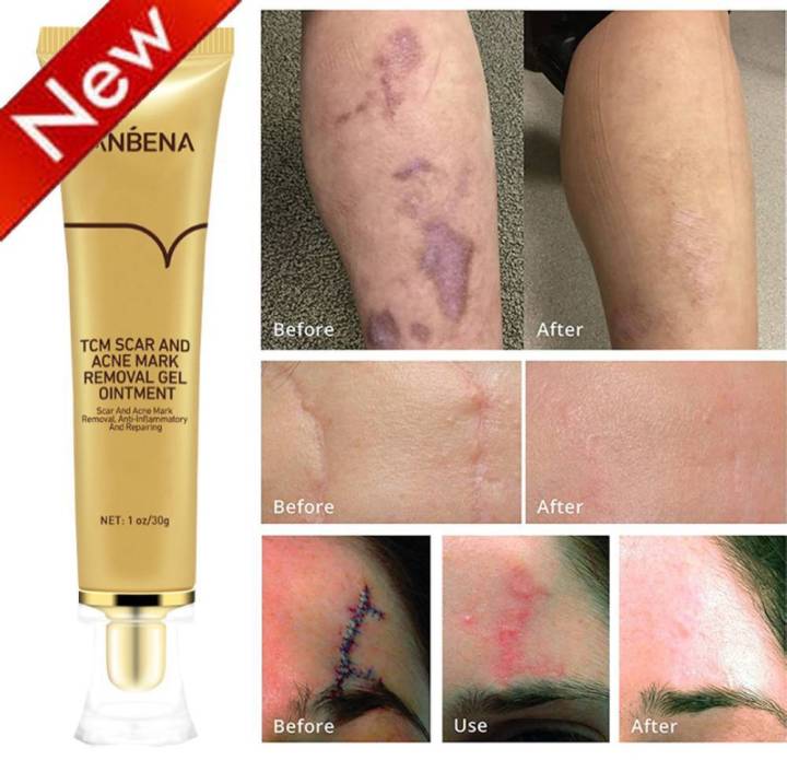 LANBENA%20-TCM%20Scar%20And%20Acne%20Mark%20Removal%20Gel-%2030g%20-%20Image%202