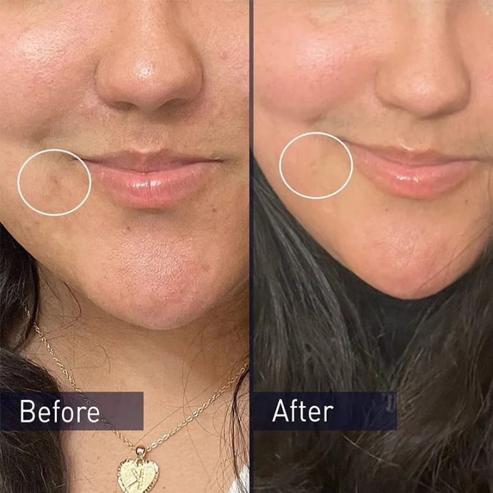 Facial%20Cleanser%2010%25%20Benzene%20Peroxide%20Deep%20Clean%20Moisturizing%20Oil%20Control%20Gentle%20Nourishing%20Shrink%20Pores%20Anti-Acne%20Face%20Wash%20156g%20-%20Image%206