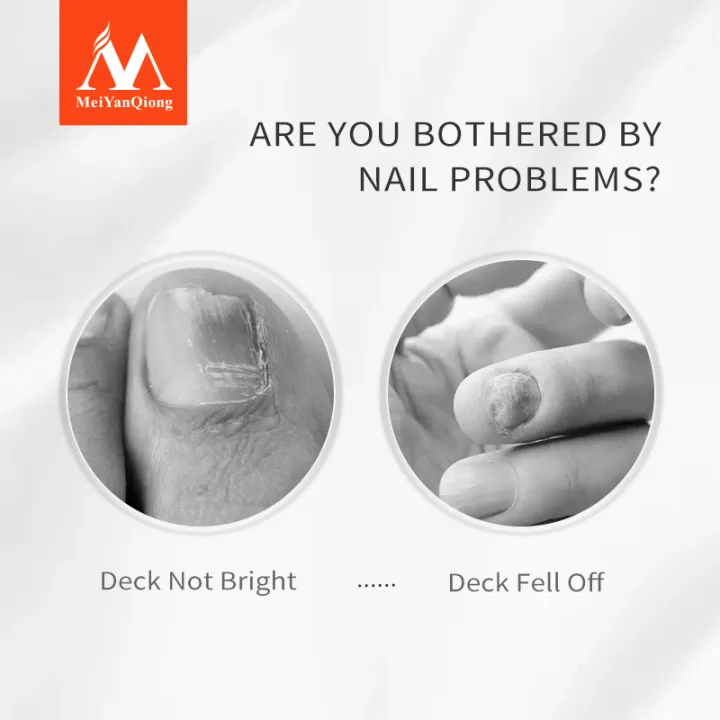 MeiYanQiong%20Lavender%20Fungal%20Nail%20Treatment%20Essential%20Oil%20Nail%20Art%20&%20Tools%20Promote%20Nails%20Grow%20Healthy%20Nail%20Treatment%20Onychomycosis%20Foot%20Care%20-%20Image%205