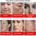 Whitening Freckle Cream Effective Remove Melasma Cream Remove Dark Spots Melanin Moisturize Brighten Smooth Face Skin Care.