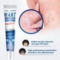 SOL LORA Aliexpress Amazon Cross-Border Wart Wart Cream Verruca Flat Wart Removing Cream Corn Plaster Verruca Flat. 