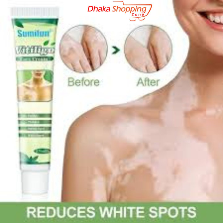 Vitiligo%20Treatment%20Cream%20Healthy%20White%20Spot%20Therapeutic%20Gel-Bath%20&%20Body%20Accessories%20-%20SL%20Discount%20Shop%20-%20Image%202