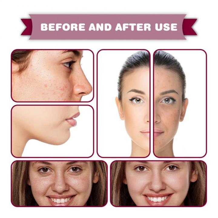 30ml%20AHA%2030%25%20+%20BHA%202%25%20Face%20Serum%20Fruit%20Acid%20Acne%20Oil%20Control%20Remove%20Blackheads%20Shrink%20Pores%20Skin%20Texture%20Improve%20Care%20-%20Image%204
