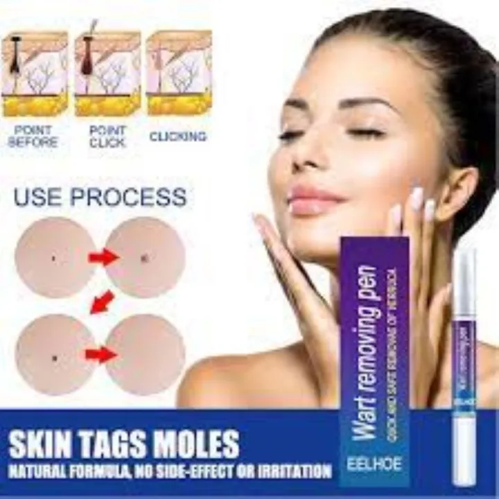 Eelhoe%20Doctor%20Proven%20Verruca%20&%20Wart%20Removing%20Pen%20-%20Image%202