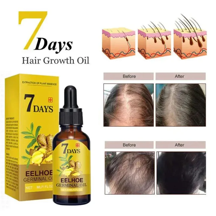 5pcs%207%20Days%20Fast%20Ginger%20Hair%20Growth%20Serum%20Anti%20Hair%20Loss%20Fast%20Growing%20Hair%20Care%20Essential%20Oil%20Repair%20Damaged%20For%20Women%20Men%20200ML%20BruberryBeE%20-%20Image%205