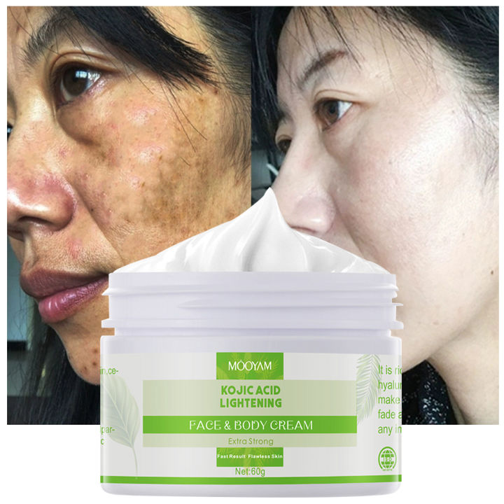 Kojic Acid Face Cream Whitening Remove Freckles Dark Spots Anti Aging Brighten Moisturizing Nourishing Korean Skin Care Health