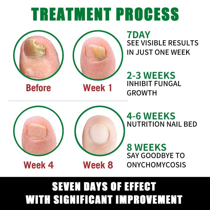 7DAYS%20Repair%20Nail%20Fungus%20Treatments%20Essence%20Foot%20Care%20Serum%20Toe%20Nails%20Fungal%20Removal%20Gel%20Anti-Infection%20Onychomycosis%20Care%20Tool%20-%20Image%204