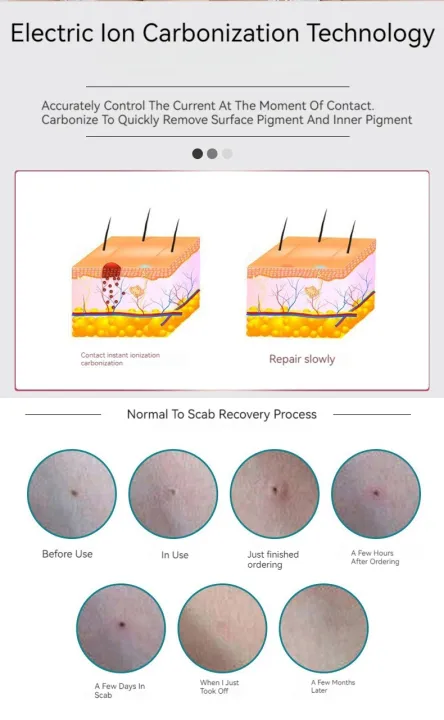 9%20Level%20Skin%20Body%20Spot%20Wart%20Tag%20Tattoo%20Removal%20Pen%20Black%20Pore%20Dark%20Spot%20Remover%20Needle%20Remover%20Point%20Pen%20Facial%20Skin%20Care%20-%20Image%204