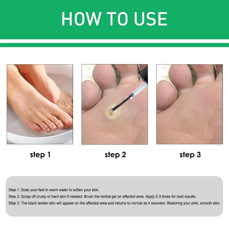 Effective Foot Corn Remover Care Remove Foot Calluses Remove Warts