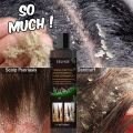 Treatment Of Psoriatic Seborrheic Dermatitis With Anti Tinea Capitis And Anti Itching Shampoo Anti Dandruff And Oil Control Hair. 