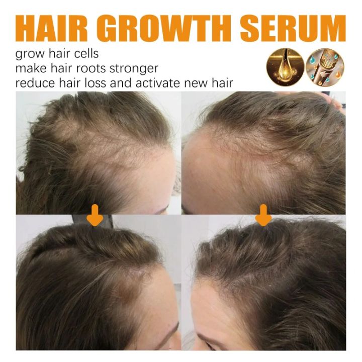30ml%20Biotin%20Fast%20Hair%20Growth%20Products%20Anti%20Hair%20Loss%20Serum%20Spray%20Prevent%20Baldness%20Treatment%20Scalp%20Beard%20Beauty%20Hair%20Care%20For%20Men%20Women%20-%20Image%205