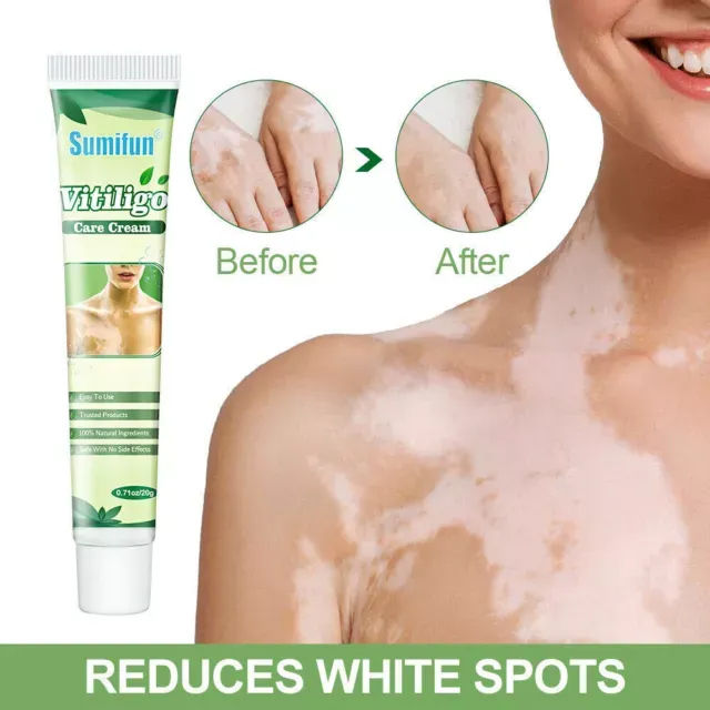 Sumifun%20Vitiligo%20Cream%20Reduces%20White%20Spots%20and%20Improves%20Skin%20Pigmentation%2020gm%20-%20Image%202
