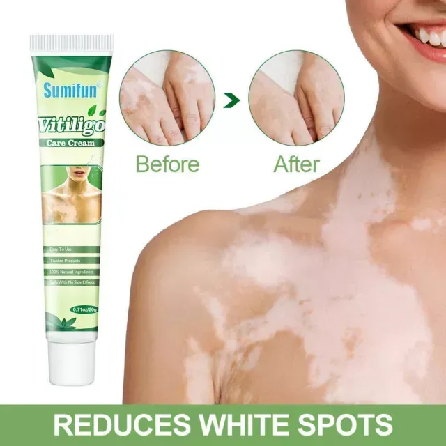 Sumifun%20Vitiligo%20Cream%20Reduces%20White%20Spots%20and%20Improves%20Skin%20Pigmentation%2020gm%20-%20Image%202