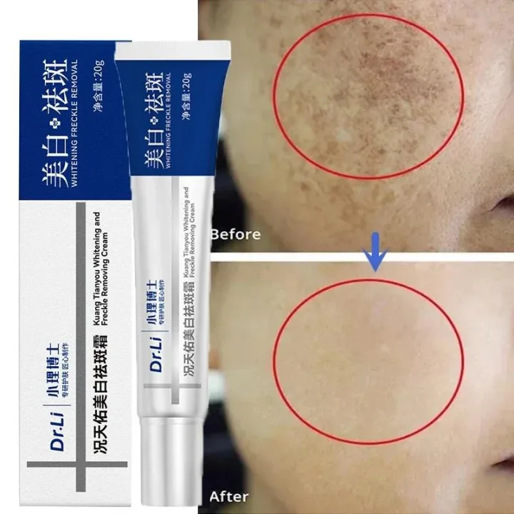 Effective%20Whitening%20Freckles%20Cream%20Remove%20Melasma%20Dark%20Spots%20Fade%20Pigmentation%20Moisturize%20Brighten%20Face%20Korean%20Skin%20Care%20Product%20-%20Image%203