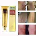 LANBENA TCM scar and Acne Spot Removal Gel Ointment. 