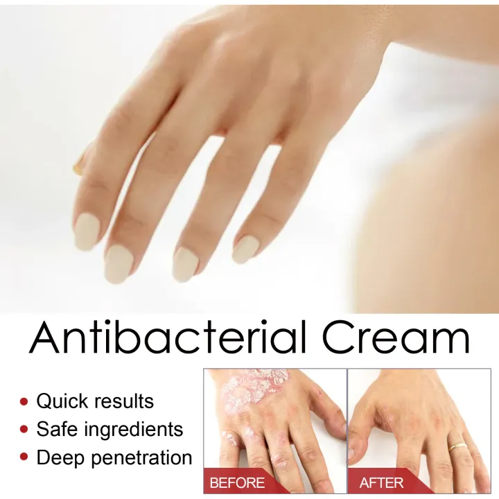 Psoriasis%20Treatment%20Cream%20Antibacterial%20Dermatitis%20Eczema%20Therapy%20Relieve%20Rash%20Urticaria%20Skin%20Herbal%20Skin%20Anti%20Itch%20Ointment%2030g%20-%20Image%204