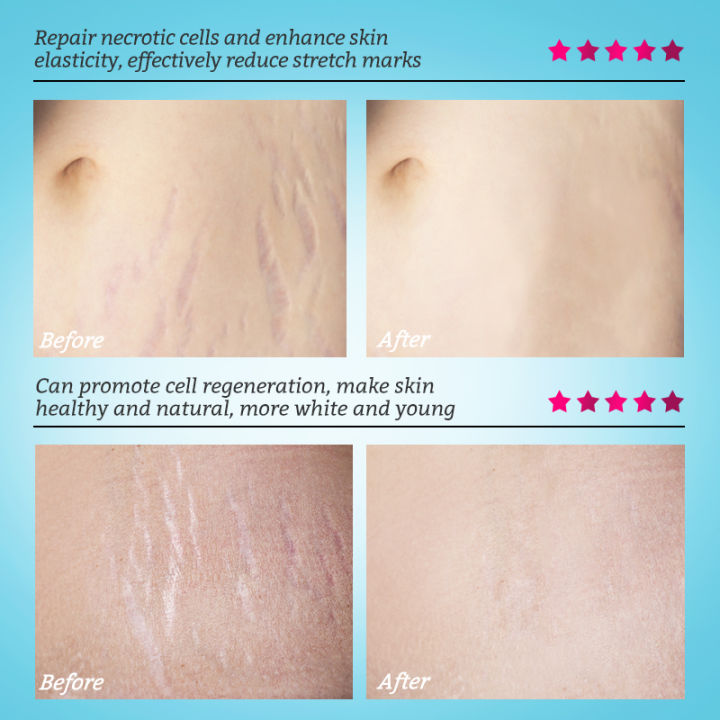 RtopR%20Mango%20Stretch%20Mark%20Cream%20Stretch%20Mark%20Repair%20Maternity%20Repair%20Cream%20Anti-Aging%20Anti-Wrinkle%20Firming%20Whitening%20Body%20Cream%2040g%20-%20Image%208